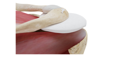 肩袖功能重建球囊