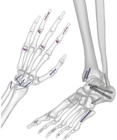非锁定金属空心接骨螺钉